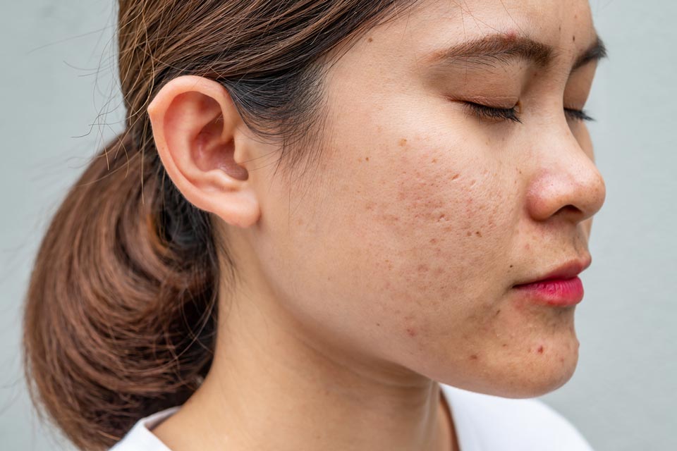 Pigmentation-Melasma-Rosacea-Photofacial