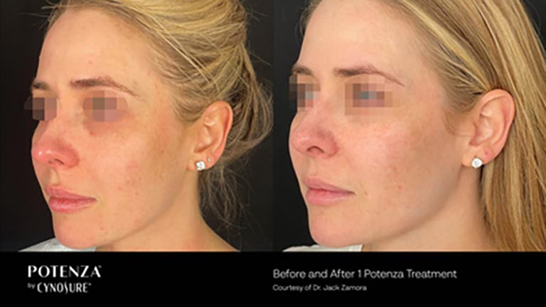 Potenza-Before_After-1