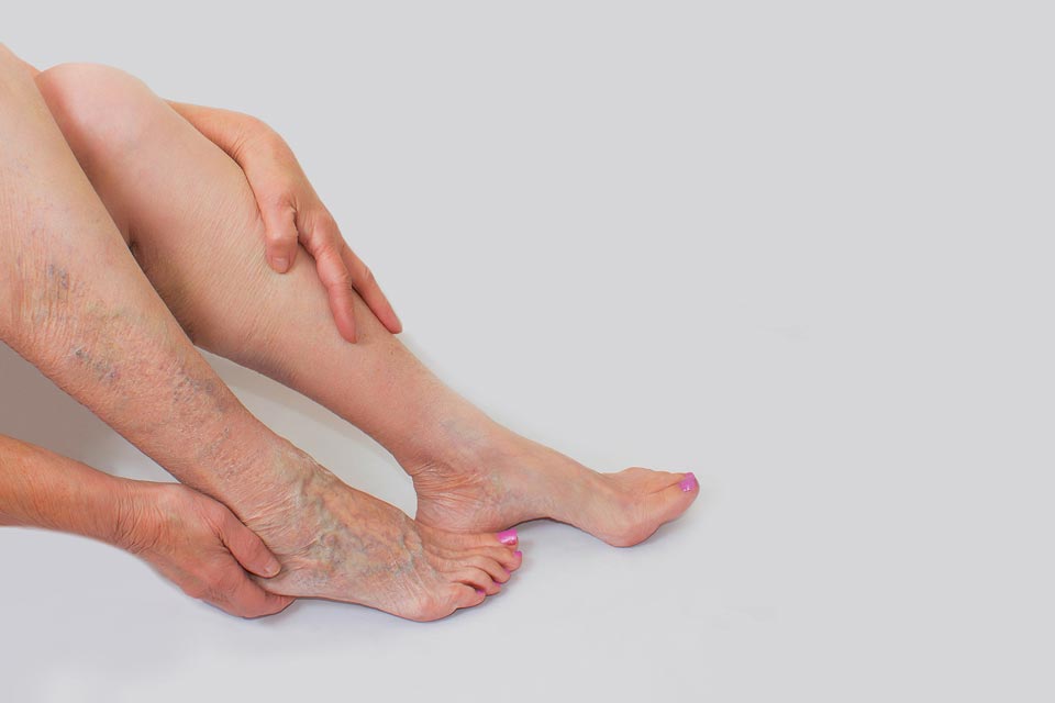 Vein-Treatment