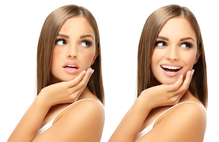 What Is Hyperpigmentation?